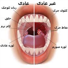 بزرگی لوزه ها